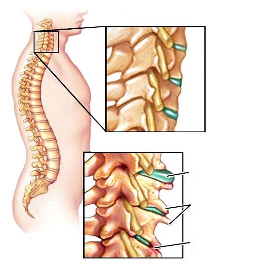 Coloană vertebrală sănătoasă și osteochondroză deteriorată