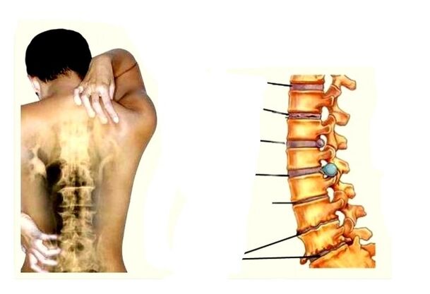 Etape de dezvoltare a osteochondrozei