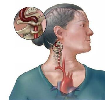 Osteochondroza cervicală duce la distrugerea discurilor intervertebrale ale coloanei vertebrale