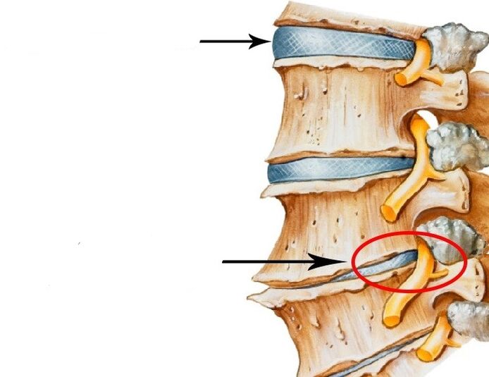 discul deteriorat și nervul încălcat cu osteocondroză cervicală