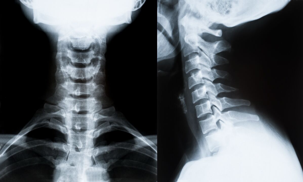 osteocondroza cervicală la radiografie